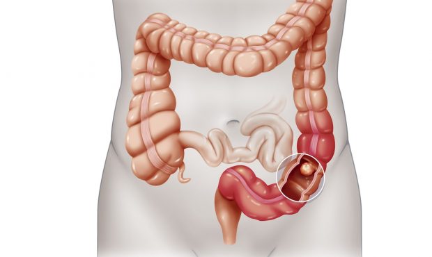 The American Cancer Society's newly updated guidelines for colon and rectal cancer screening recomm...