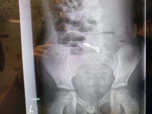 Mikah Arvidson had to have emergency surgery after he accidentally swallowed a handful of fidget magnets.