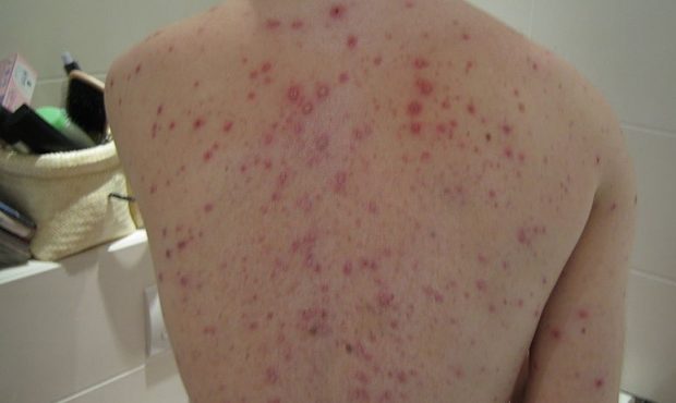 FILE: This image shows chickenpox on a man's back. (Photo: Creative Commons)...