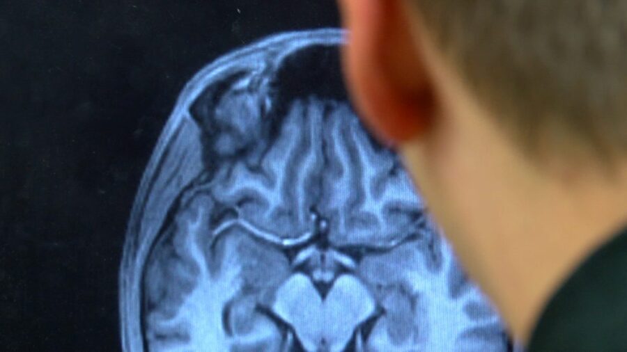 FILE - A radiologist, Jeff Anderson, peers over a scan of a brain consumed by Alzheimer's disease. ...