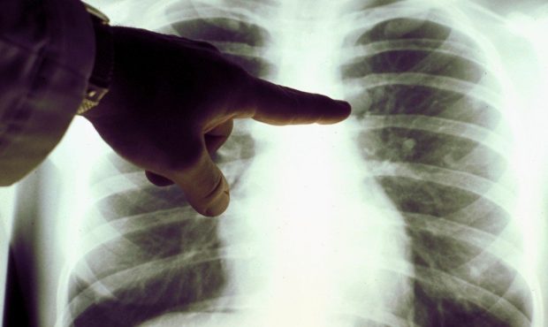 Over the past decade, the rate of new lung cancer cases diagnosed in the United States has dropped ...
