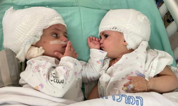 Formerly siamese Israeli twins look at one another after having undergone rare separation surgery a...