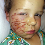 A Sandy, Utah child survived a dog attack but required hundreds of stitches