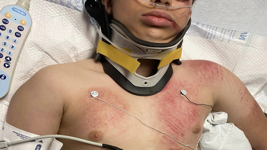 Tire marks are visible on 13-year-old Isaiah Munger's chest after he was hit by a car while riding ...