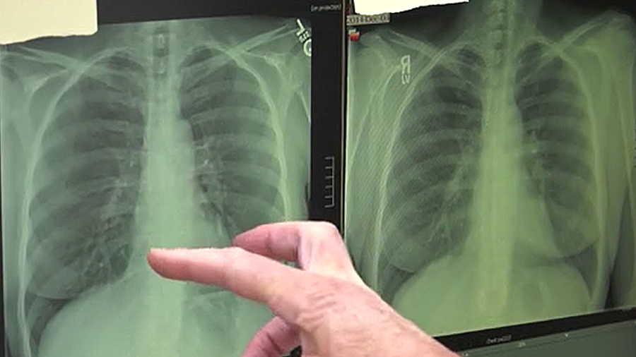 Pulmonary fibrosis leaves the lungs with severe scaring. (KSL TV)...