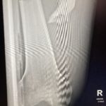 Travis Haussener showed us the x-rays of his fractured femur. (Travis Haussener)