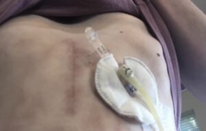 Gracelyn Wilkinson's scarred stomach with hospital equipment attached. 