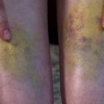 The bruises Aubree Winn suffered in October 2023. (KSL TV)